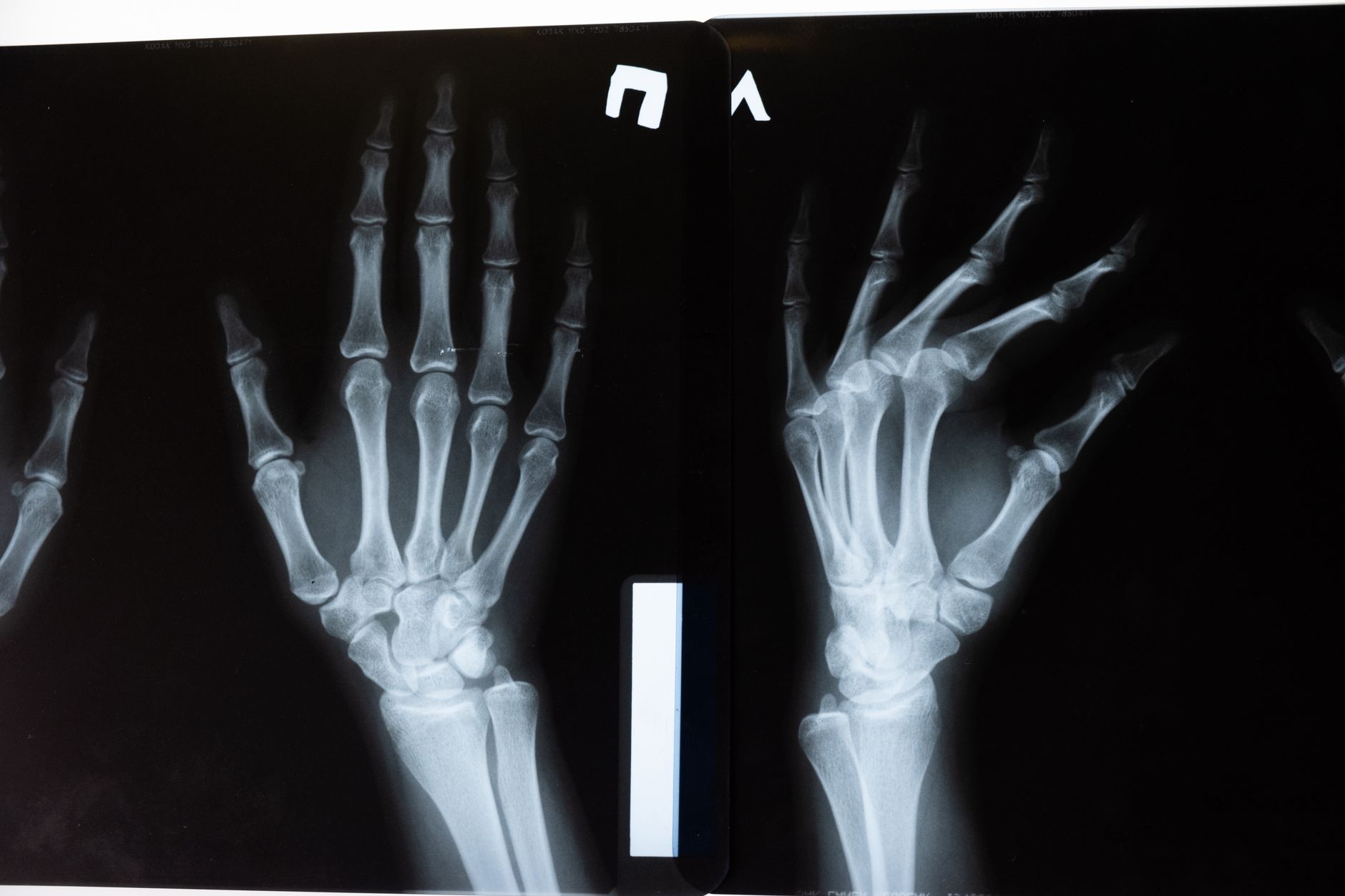Bone density osteoporosis health